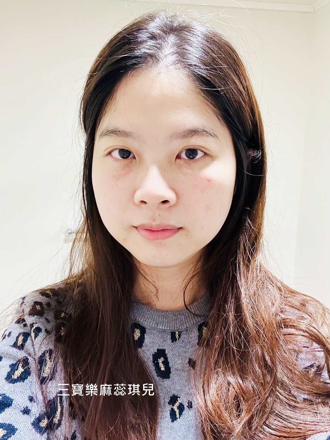媽咪愛漂亮|電音雙波愛美不再哀哀叫!佳思優醫美診所的緊膚新科技【NEW DOUBLO新倍提】 - 第20張圖