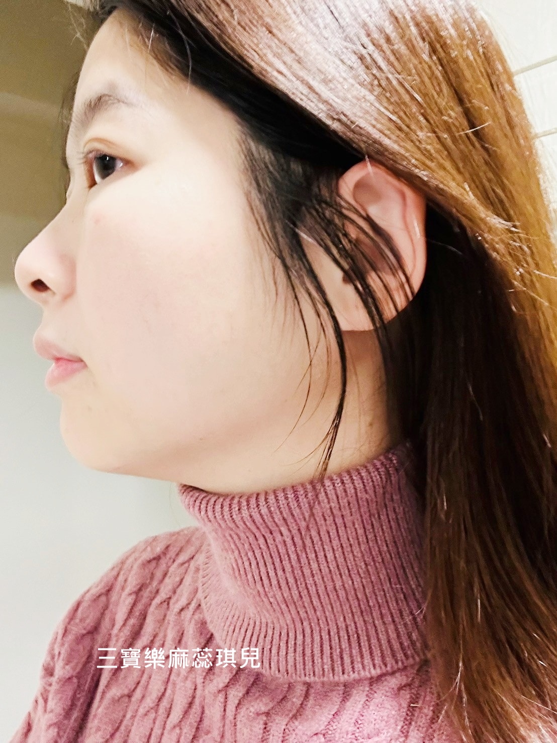 媽咪愛漂亮|電音雙波愛美不再哀哀叫!佳思優醫美診所的緊膚新科技【NEW DOUBLO新倍提】 - 第24張圖